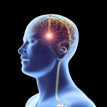 Functional Neurosurgery