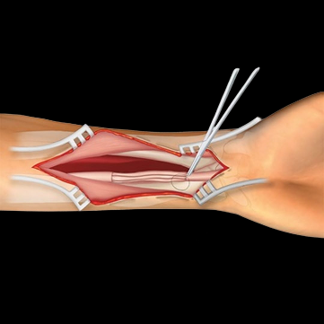 Peripheral Nerve Surgery